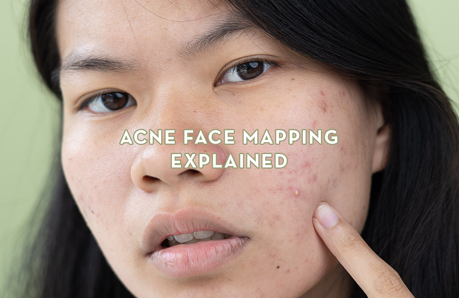 Acne Face Map