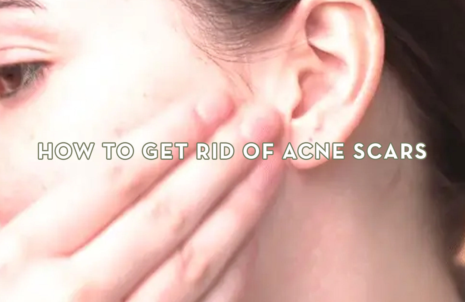 How to Get Rid of Acne Scars