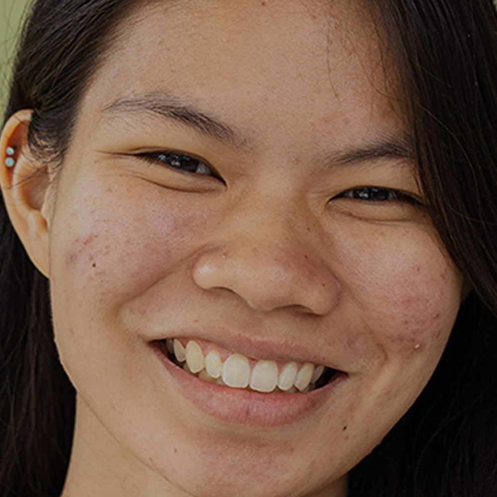 Woman with acne