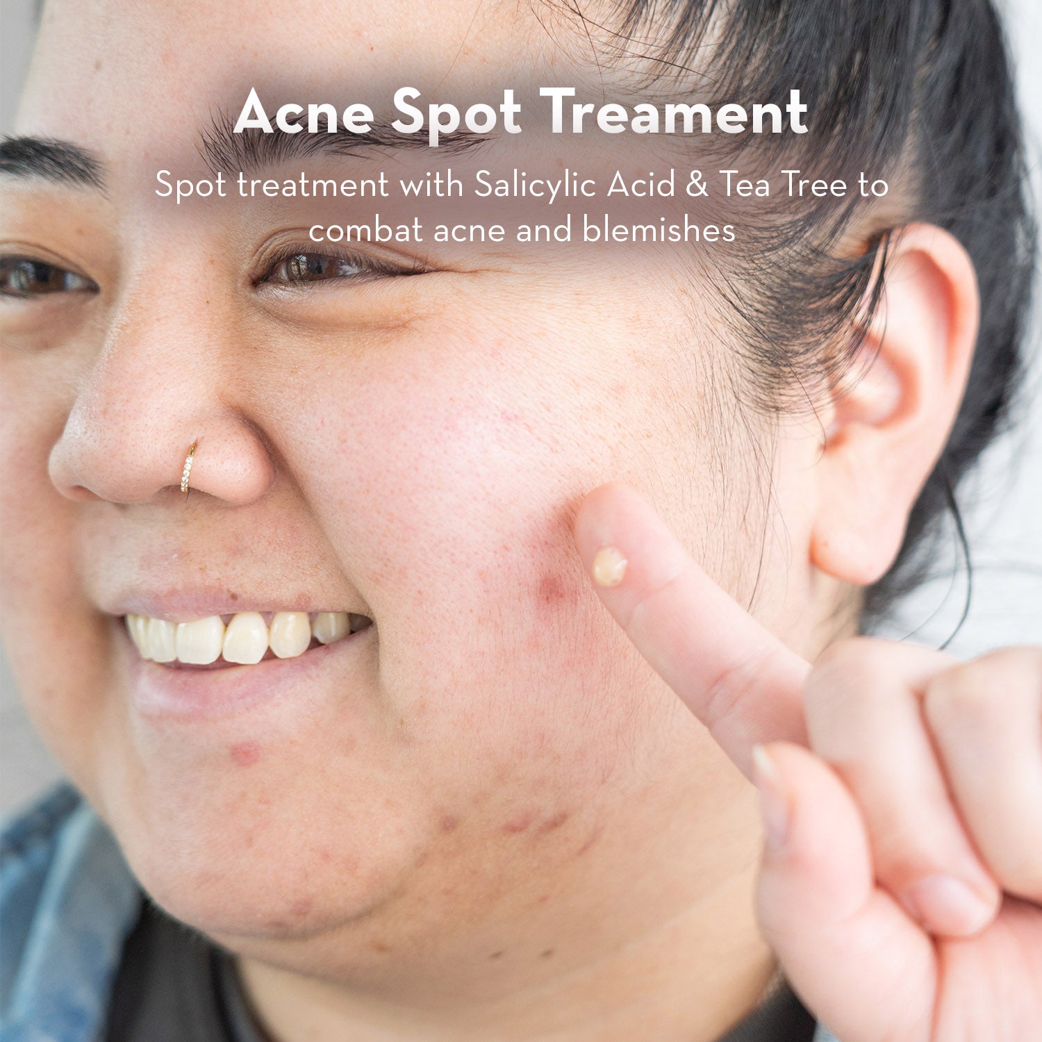 Zitlox Salicylic Acne Gel®