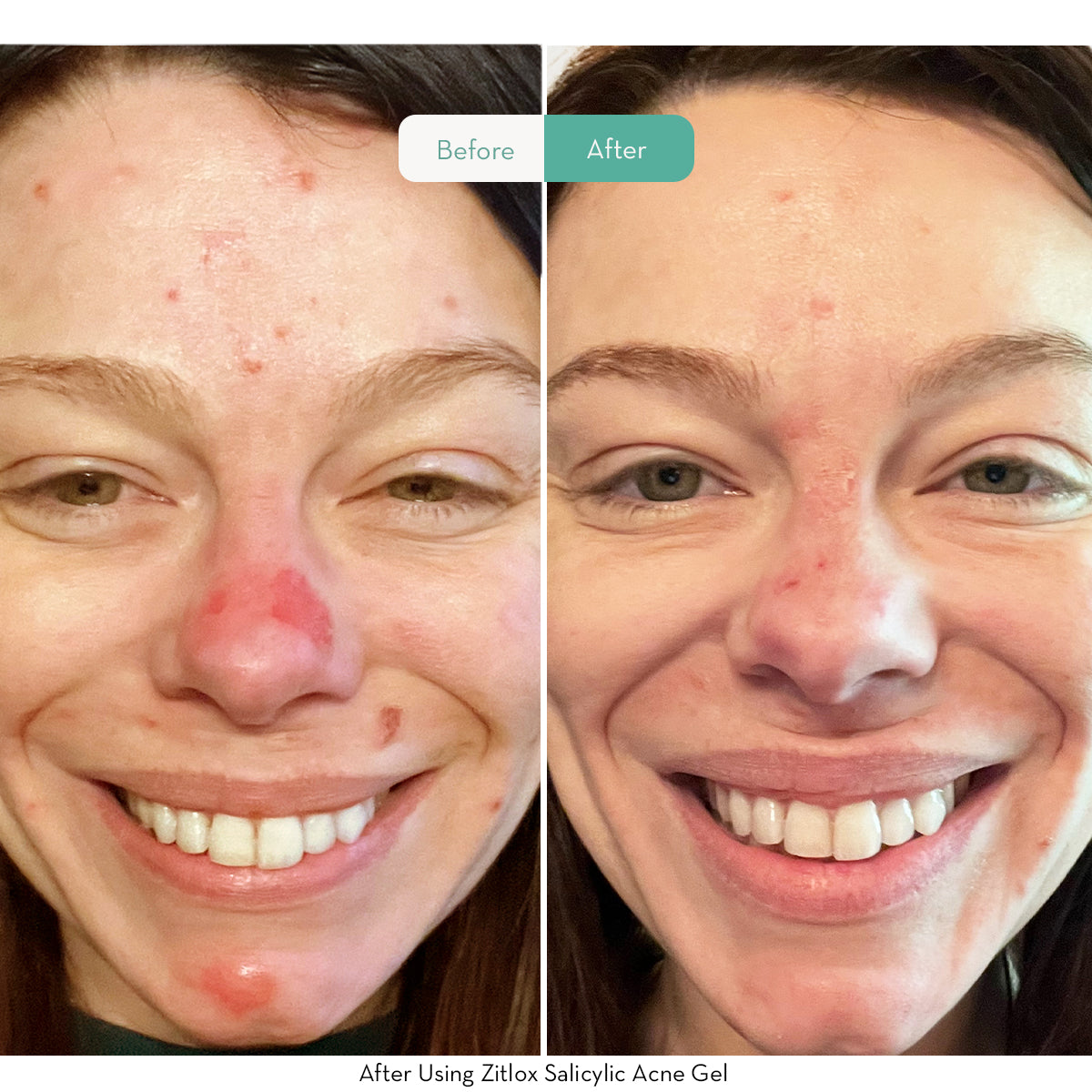 Zitlox Salicylic Acne Gel®