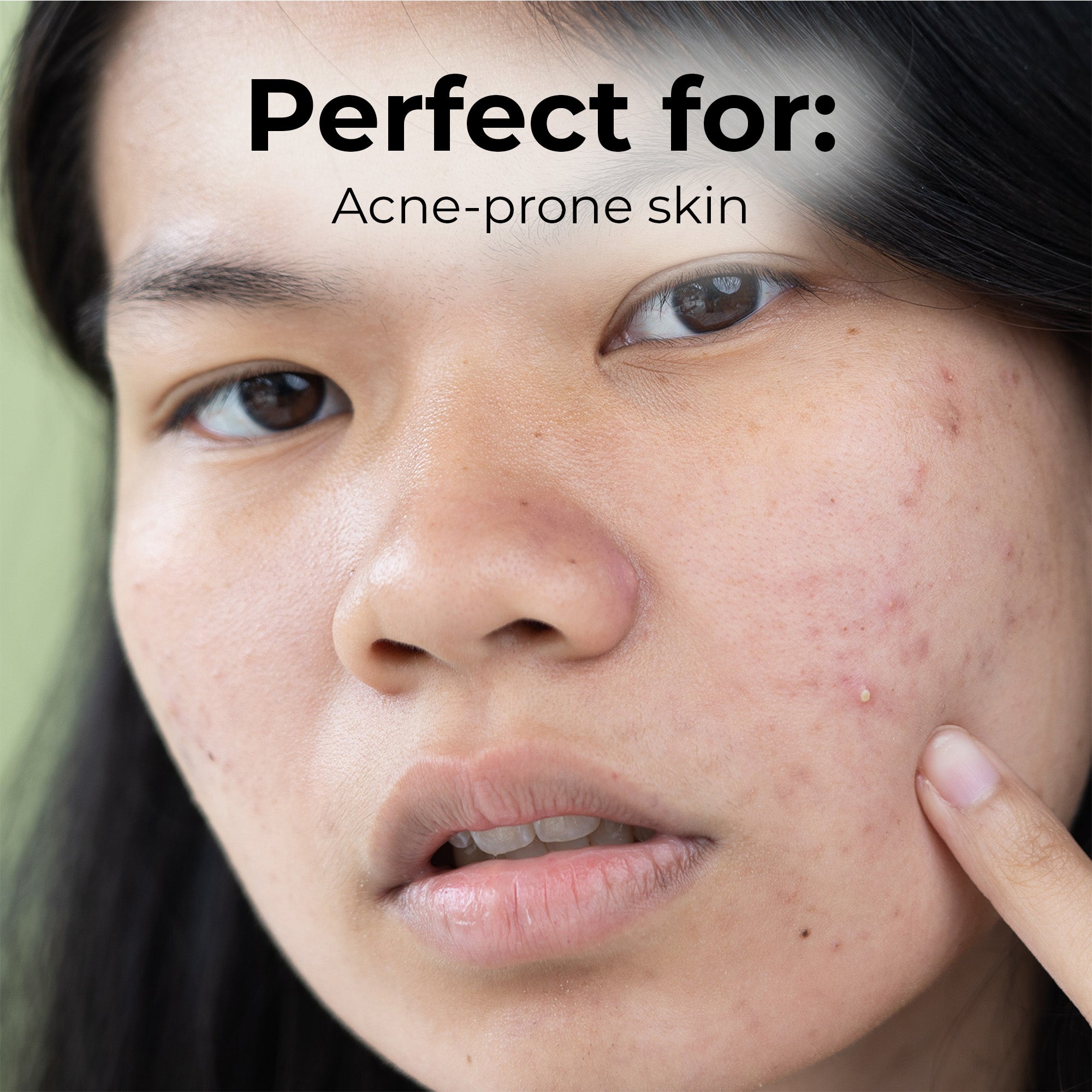Acne Spot Treatment with Salicylic Acid