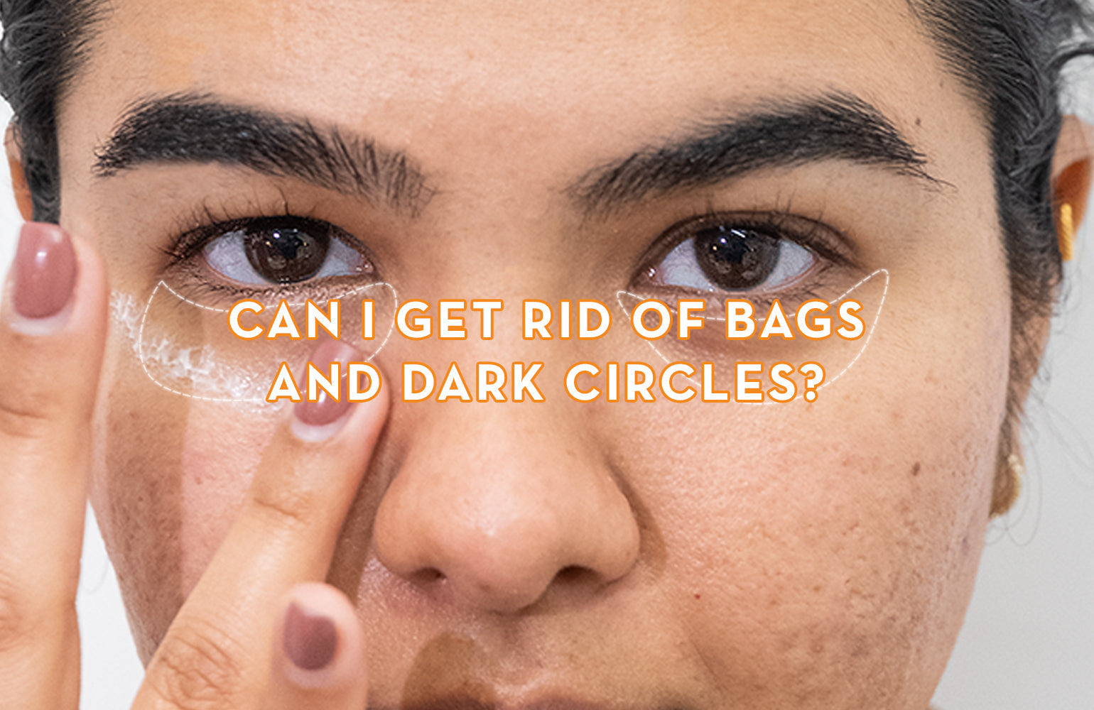 Can I Get Rid of Bags and Dark Circles Under My Eyes?