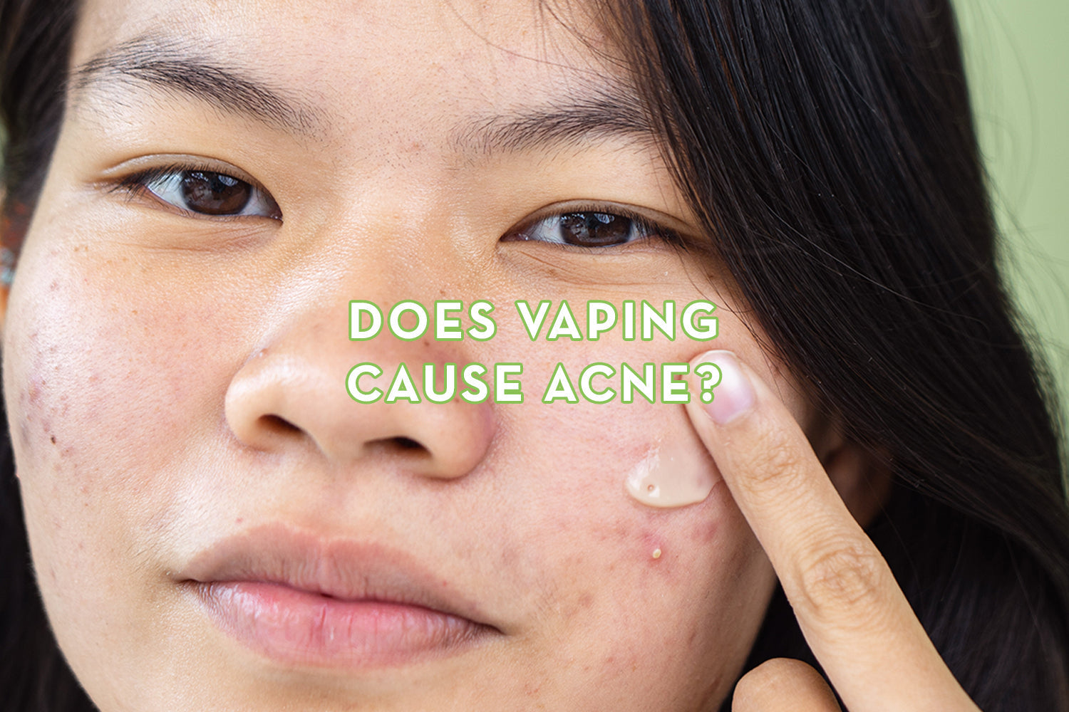 Does Vaping Cause Acne?