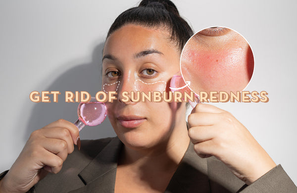 Get Rid of Sunburn Redness