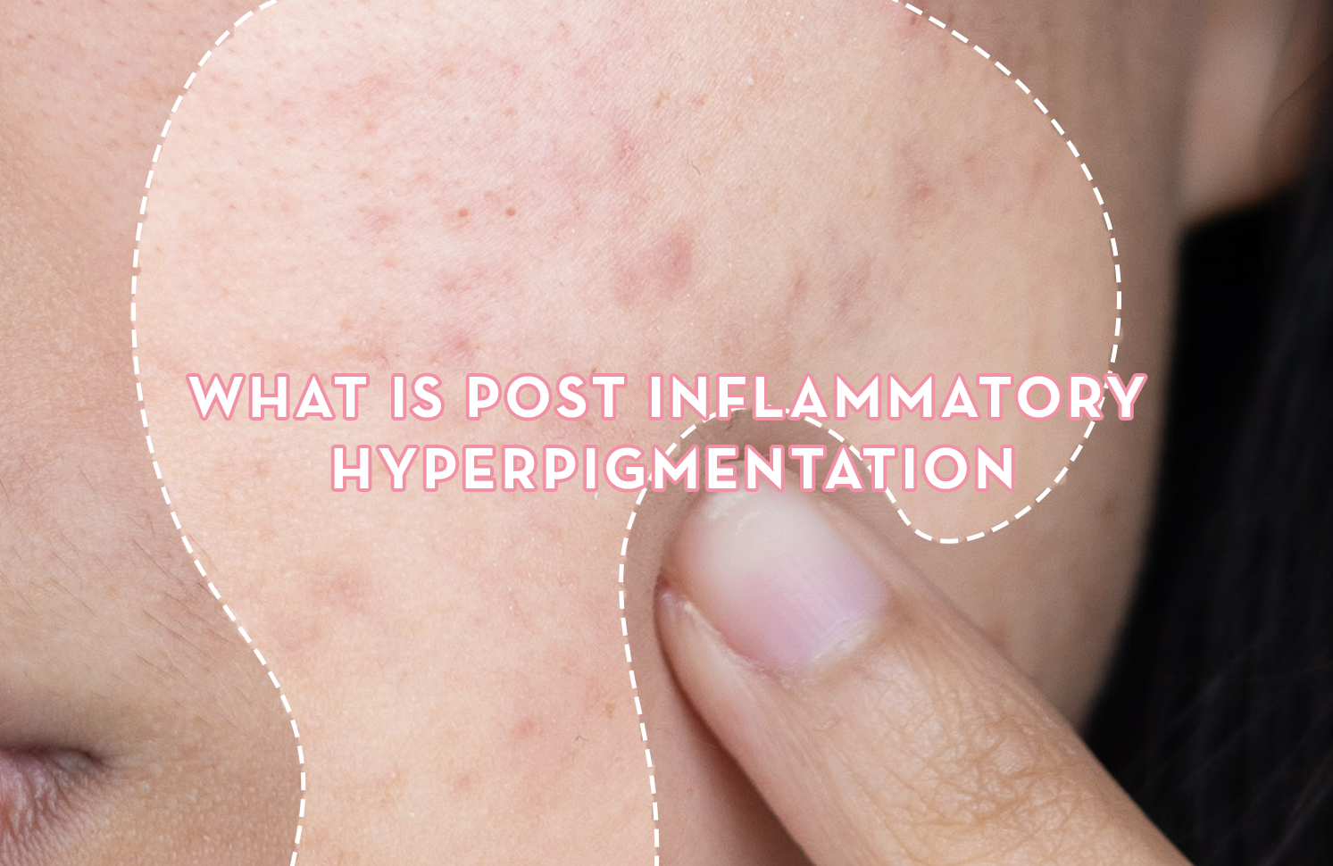 Understanding Post Inflammatory Hyperpigmentation: Causes, Treatment, and Prevention