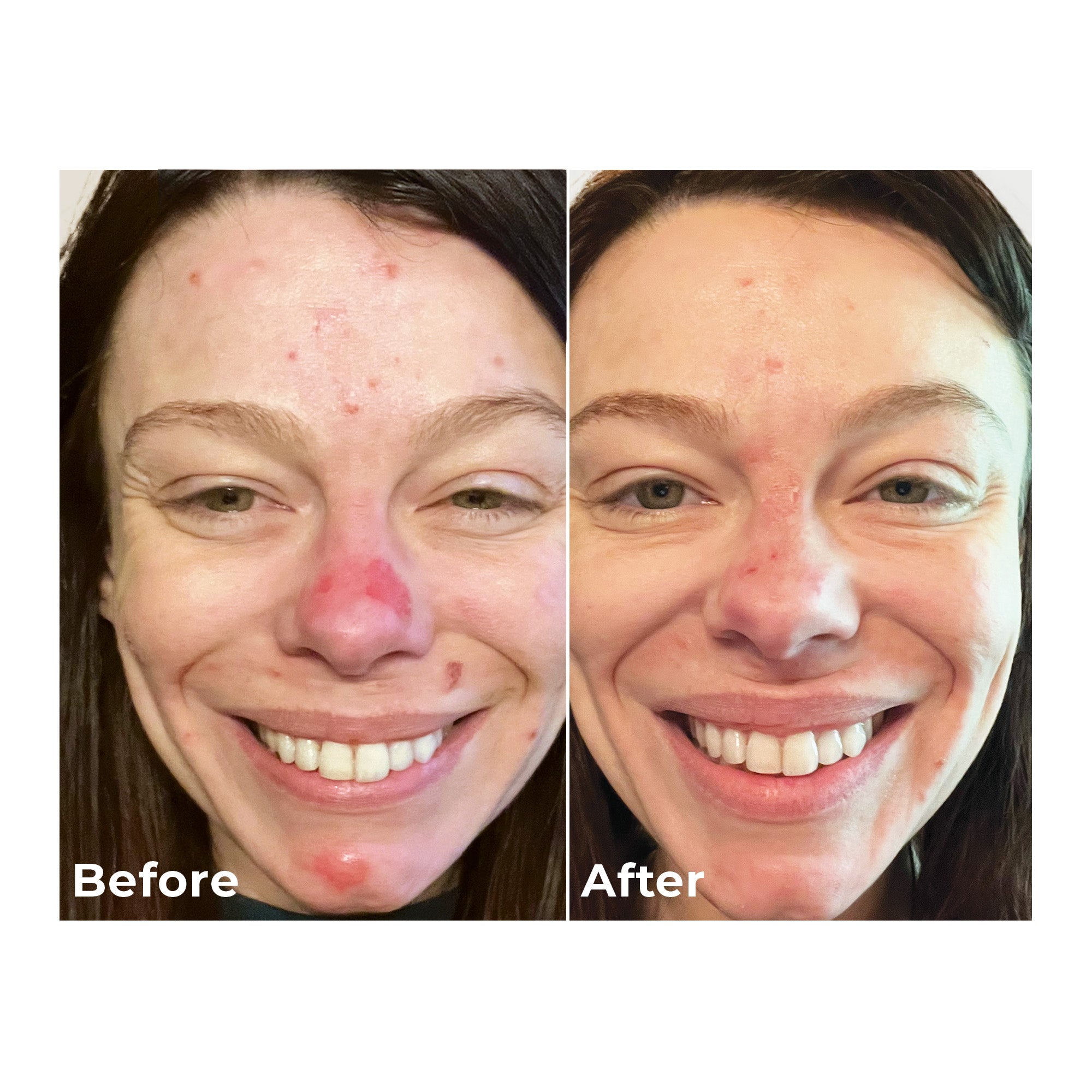 Acne Spot Treatment with Salicylic Acid