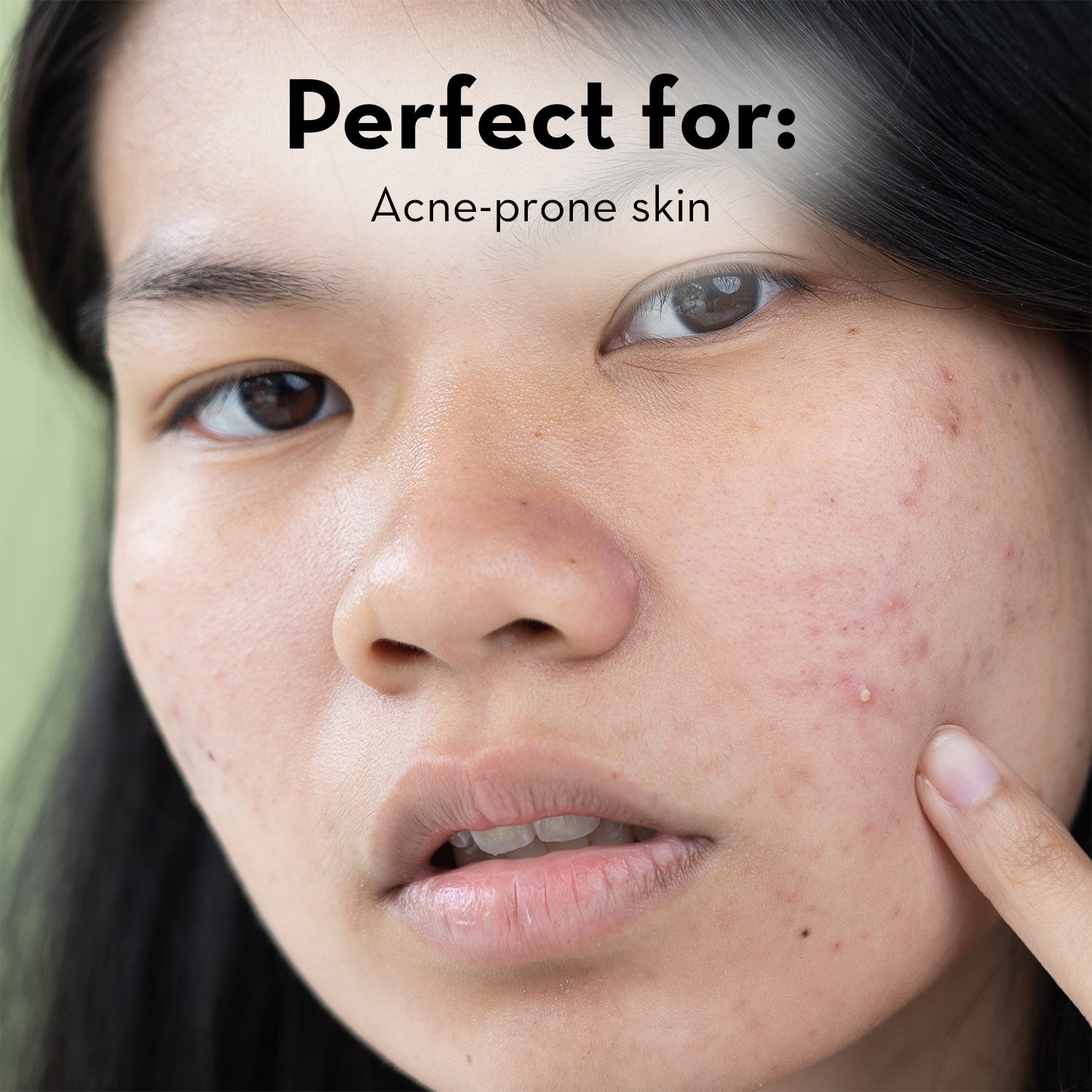 Zitlox Salicylic Acne Gel®