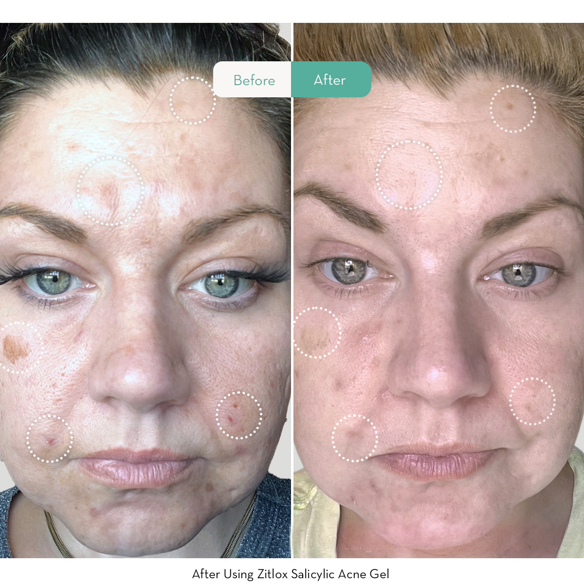 Zitlox Salicylic Acne Gel®