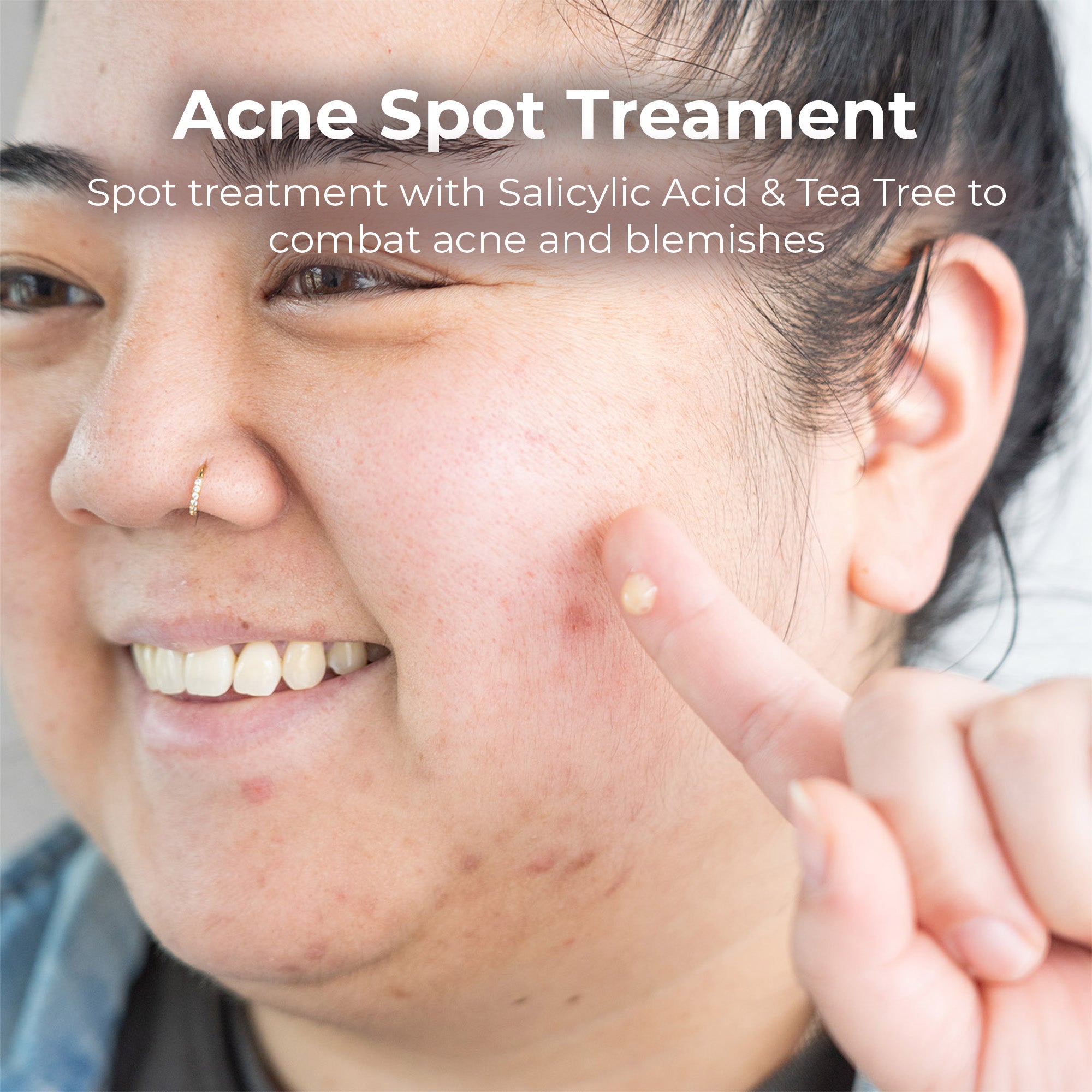 Acne Spot Treatment with Salicylic Acid