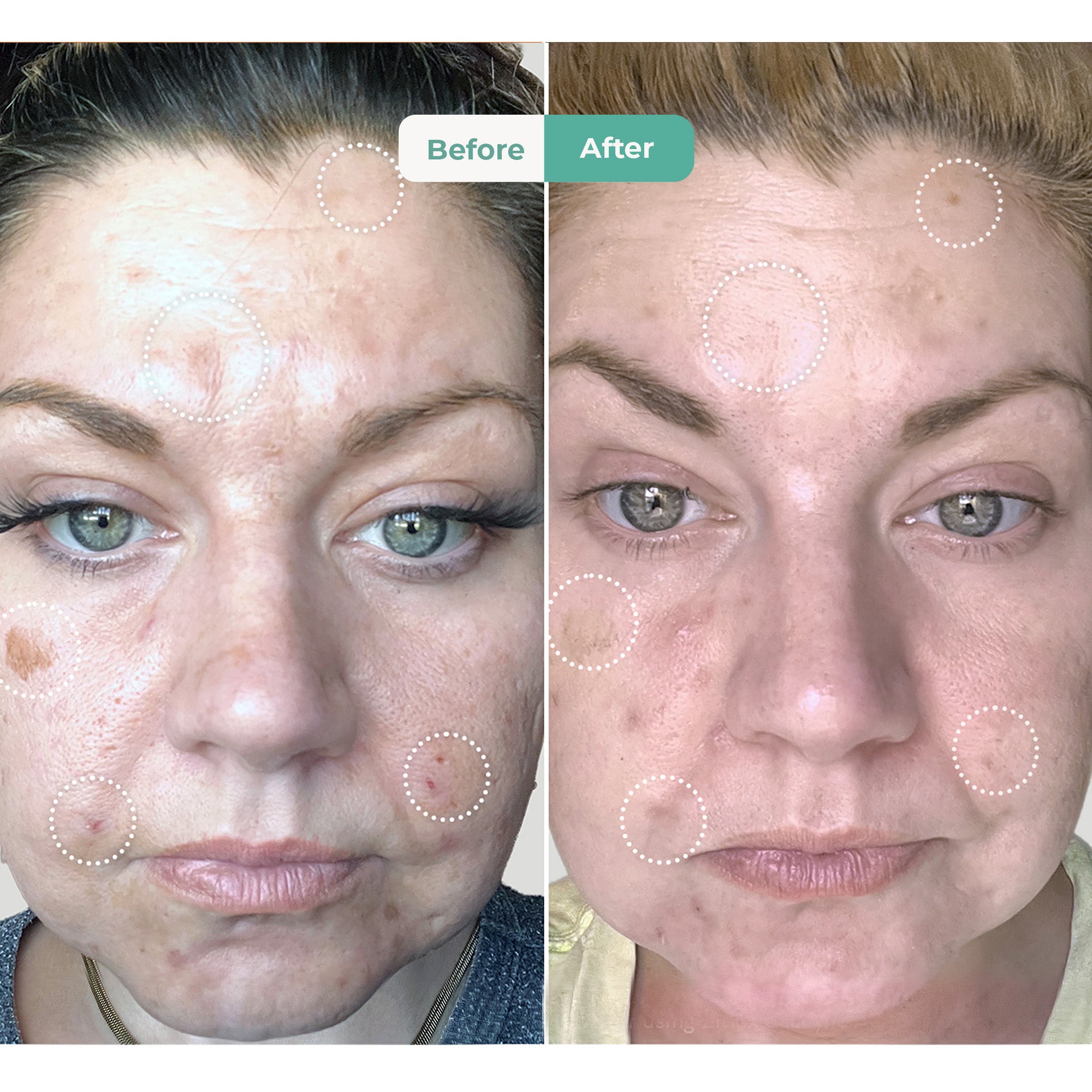 Acne Spot Treatment with Salicylic Acid